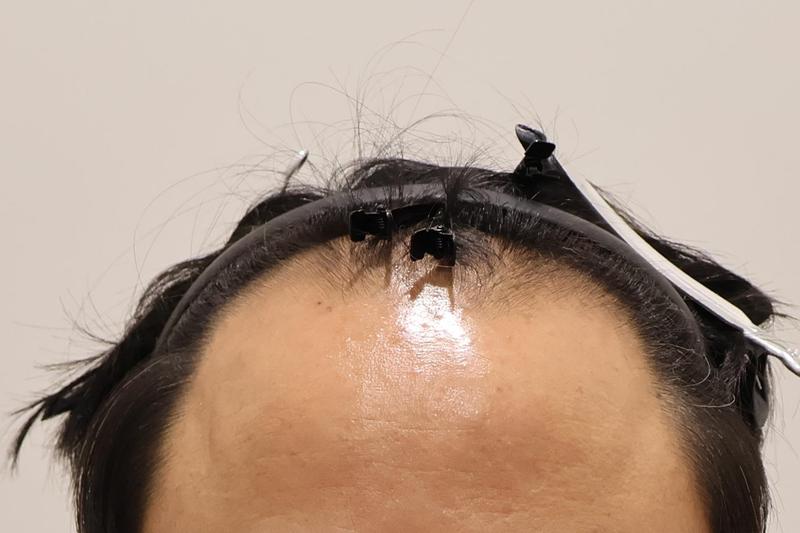 仁川Mymomo鼻切开3000块，经过2周报告。