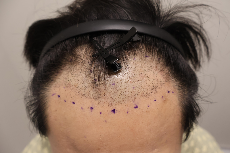 Incheon Maimo Slot Hair Transplantation 2,600 Mo 6 Months Later