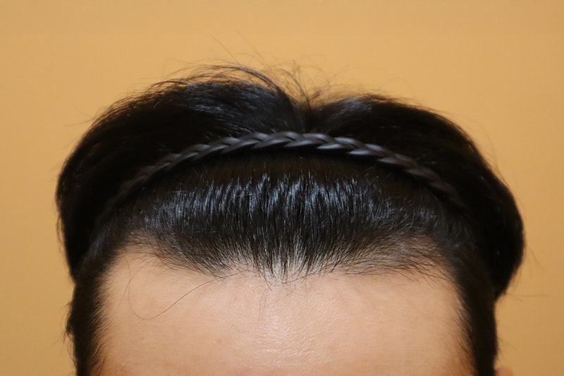 부산 헤어로의원 비절개모발이식 2400모 2주 경과 다녀왔어요