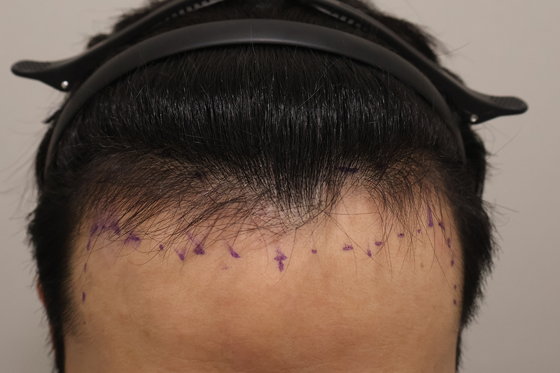 A late month review of 1600 hair follicles in Busan Hairo Clinic