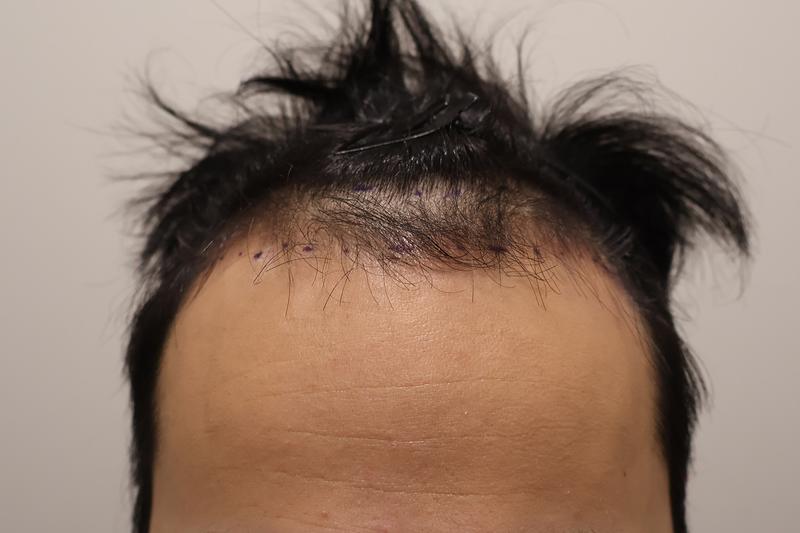 Busan Hairo Clinic Review of Non-Cutting 1400 Hair follicle Transplantation
