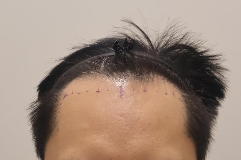 Incheon Maimo Hospital's 2800-mo transplantation 2 weeks ago