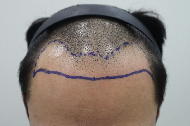 全州HAIRO医院非切开3500毛发移植手术结束了~