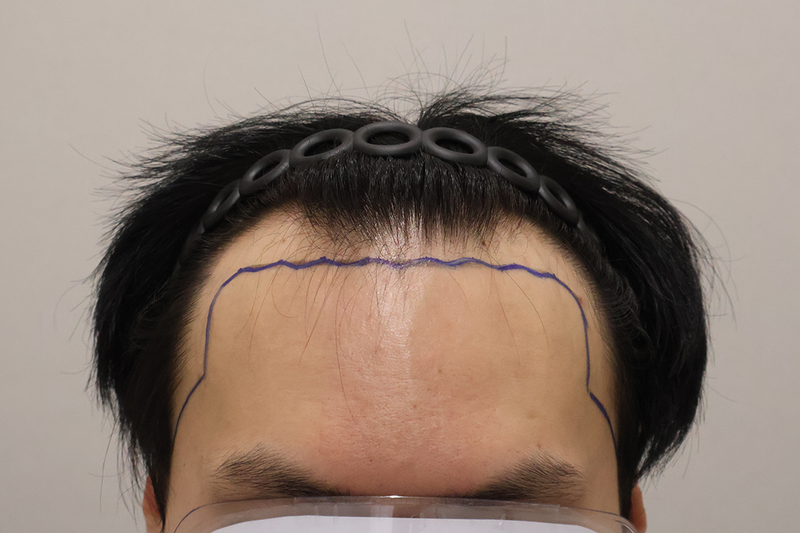 東灘ヘアで医院切開植毛11日経過