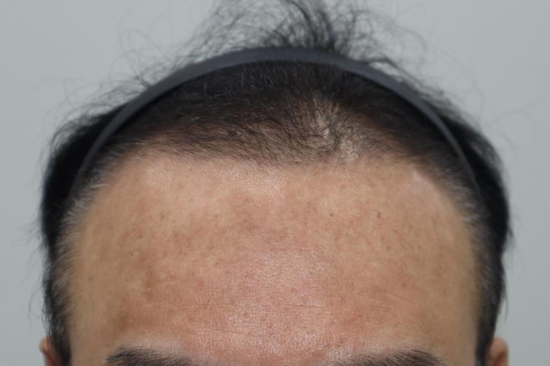 전주헤어로의원 비절개 3000모 이식받고왔습니다
