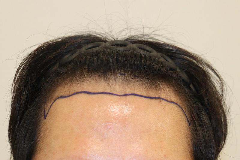 大邱ヘアロ医院切開 2400本 毛髪移植9ヶ月経過