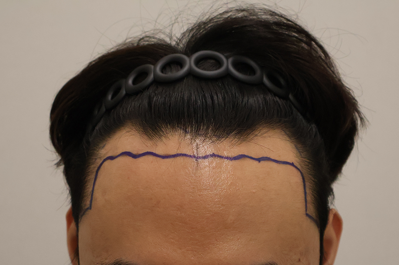 東灘ヘアで医院切開3200本の手術、10日が過ぎましたね