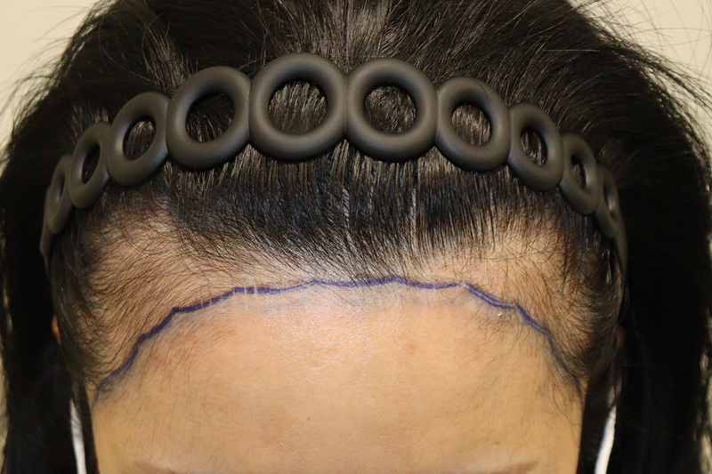Daegu Hair Orphan Clinic 2000 Hairline Correction Hair Transplantation (Non-Cutting) Week 2 Review