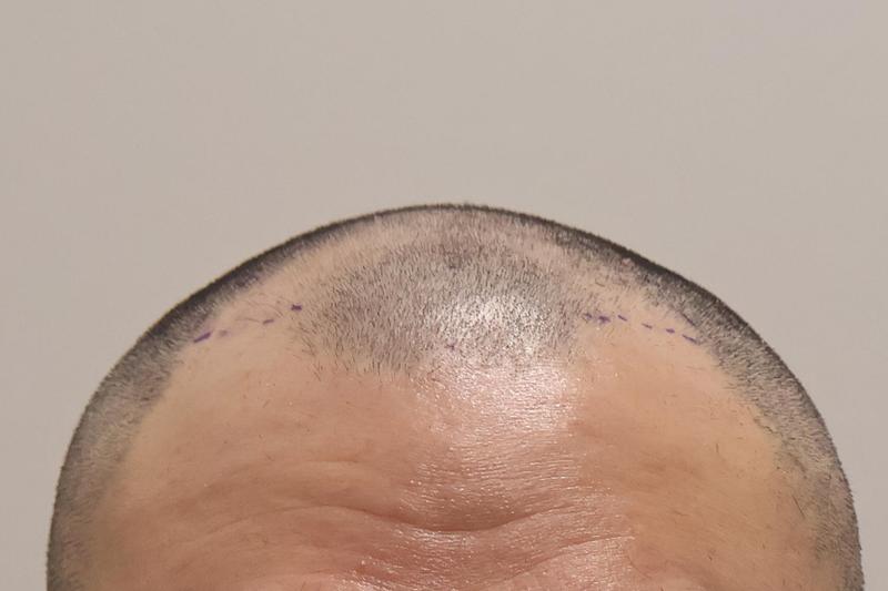 인천 마이모 비절개 3200모 3개월차 후기입니다.