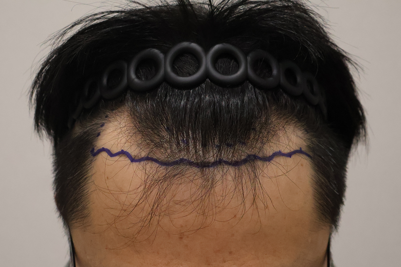 Dongtan Hairro Clinic's Non-Cutting No Cut 3300 Mo 2 Weeks and Review