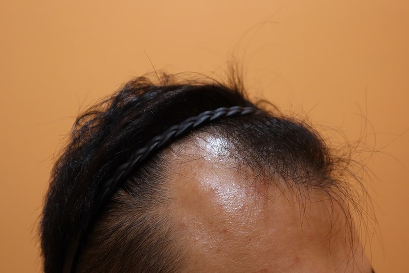 부산헤어로 4000모 비절개 모발이식 1년 졸업후기