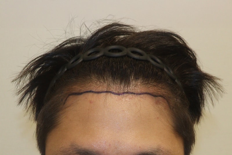 大邱ヘアロクリニック2000毛 2週間経過体験談