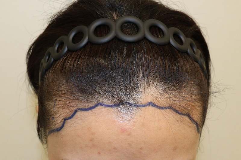 Daegu Hairo Clinic's non-cut 2400 Mo 2 weeks have passed!