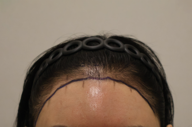 ドンタンヘアで医院切開 毛髪移植3000毛 手術から14日経過