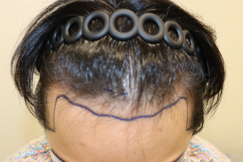 [大邱ヘアロ医院] 大邱ヘアロ医院 非切開 植毛 3200毛 体験談