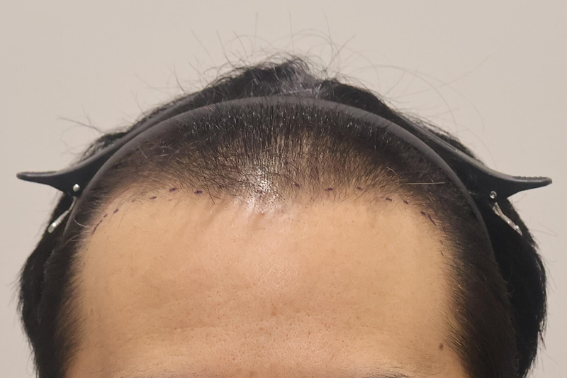 This is the review of Incheon Maimo Clinic's 1400 hair follicles for about 3 months.