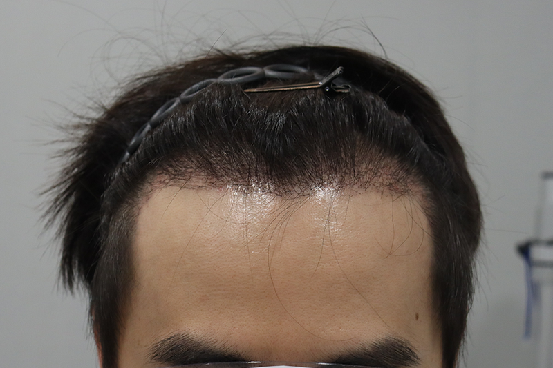 大邱ヘアで非切開で2千毛を受けた2週間後