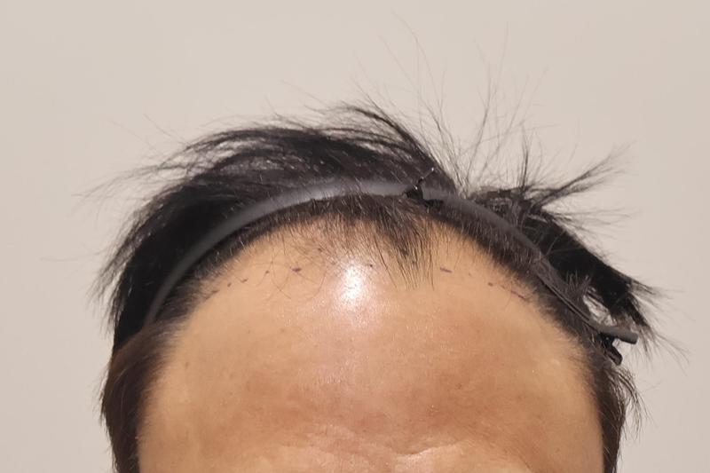 Immediately after the incision of 1,000 hair follicles at Incheon Maimo Clinic