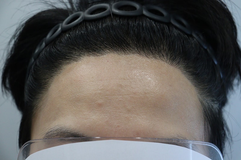 大邱ヘアロ医院1年経過後、補強2週目の後期