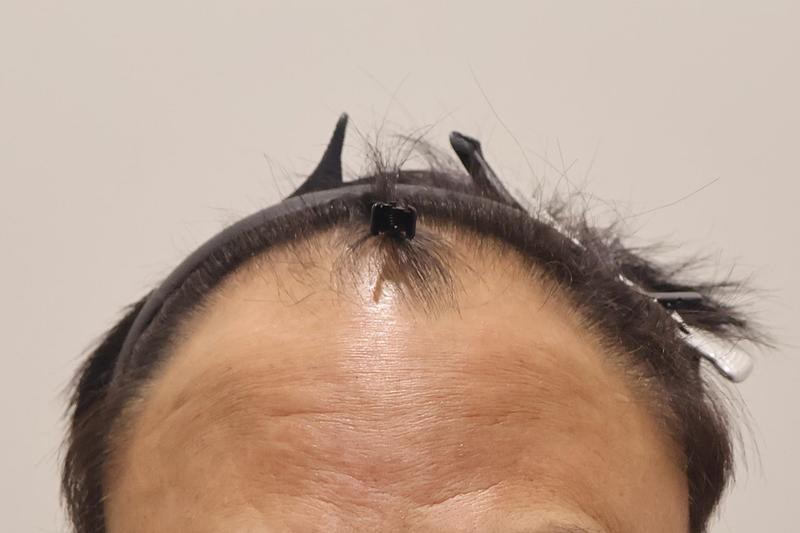Incheon Maimo Medical Center's 1,000 hair follicles a month