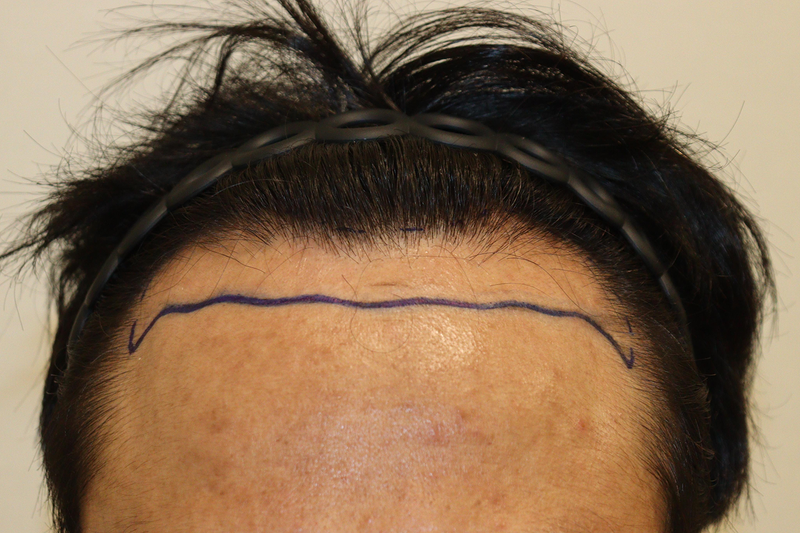 テグヘアーロで3200モ9ヶ月が過ぎました
