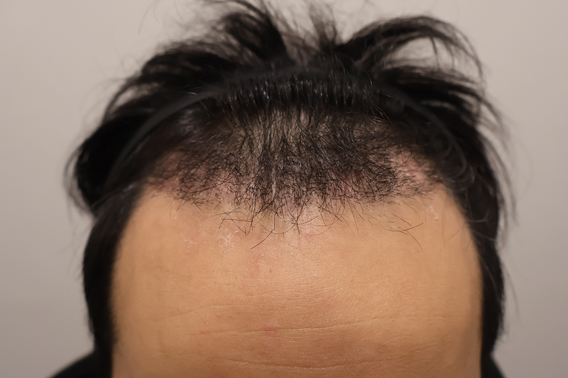Busan Hairo Clinic Non-Cutting 1400 Hair Orthopaedes A Month and a Review