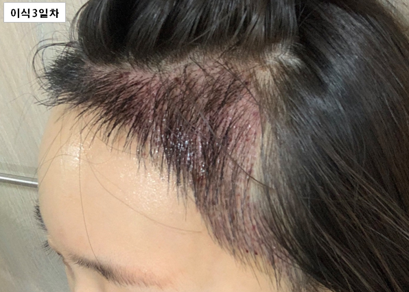 이식3일차 옆.png