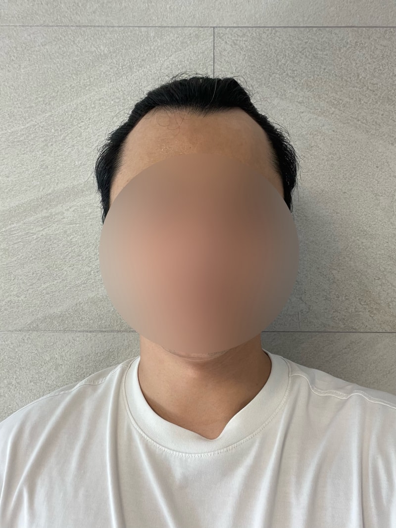 모모성형외과 모발이식1년차 후기