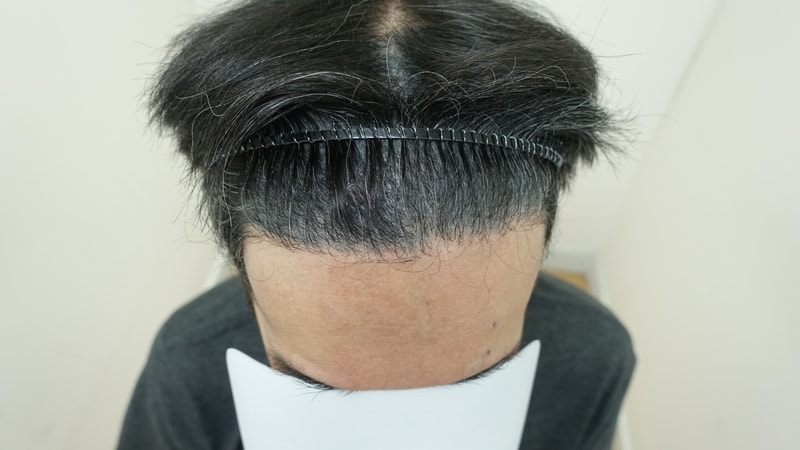 [ZARADA 医院] 3次 毛发移植 - 手术前/手术后 (4029 毛囊/非切开/完全剃头)