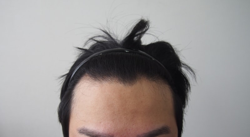 M-shaped non-cut hair transplant