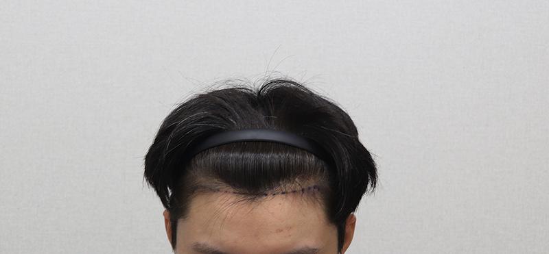 모플러스 M자 6개월 후기입니다.