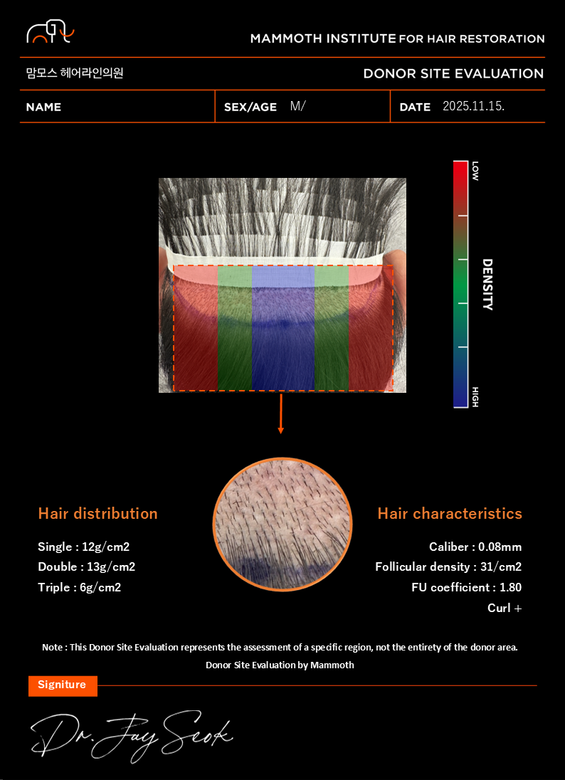 압구정 맘모스 비절개 모발이식 2차 재수술 후기 (당일)