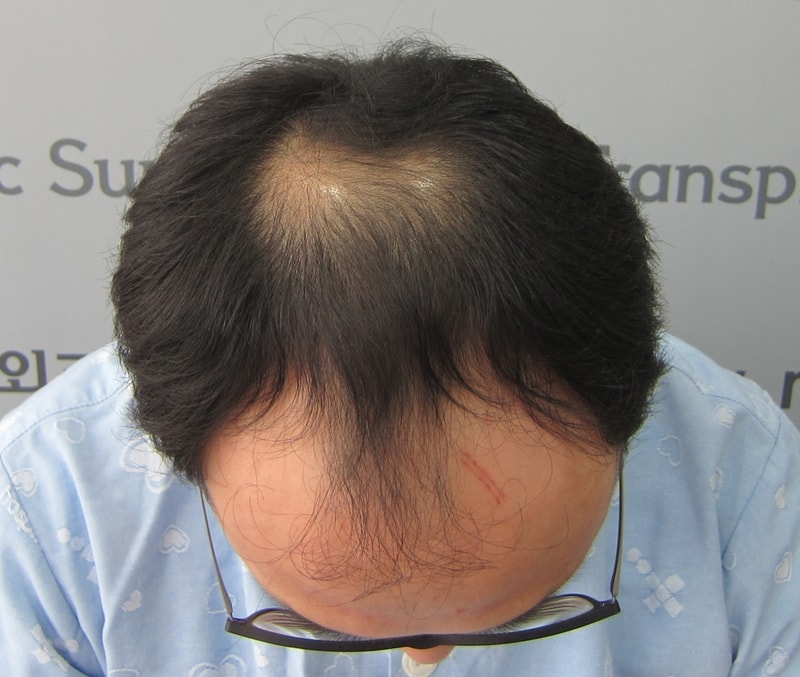 모재성에서 비절개, 4개월 후기
