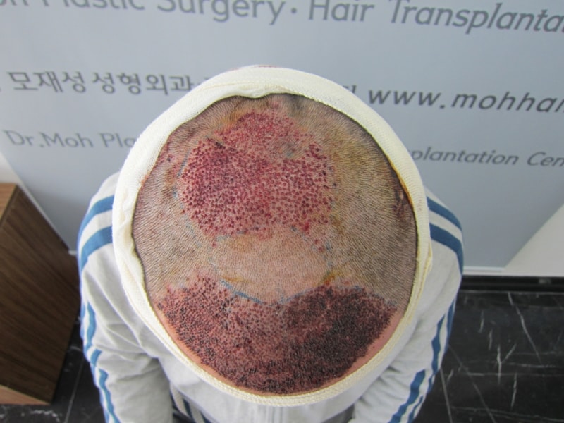 크기변환_수술직후.JPG