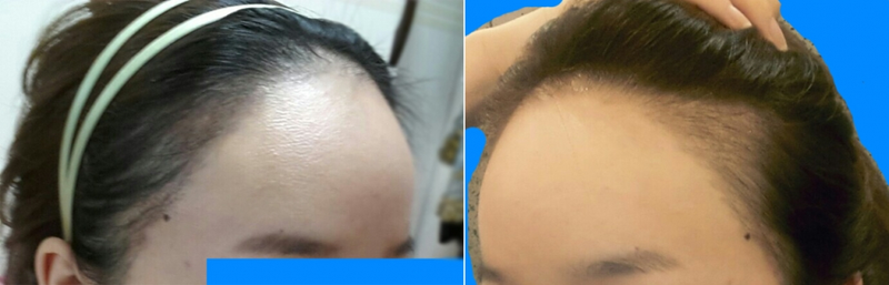 수술후90일.png