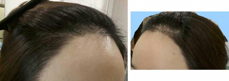 수술후7일째.png