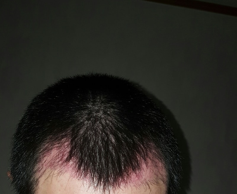 ポヘア移植6週目 1800毛包