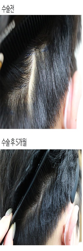 흉터전후_1.jpg