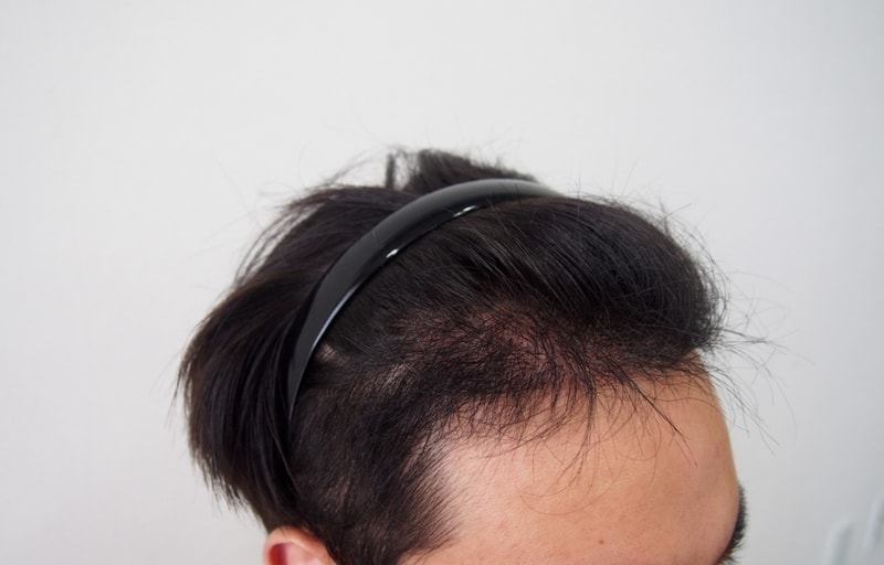 It's been about four and a half months since the non-cut surgery.