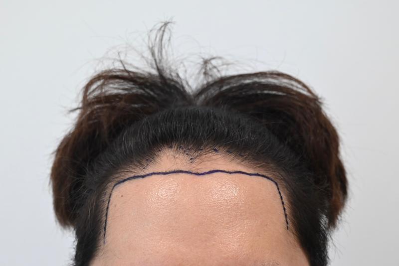 This is a review of 2,300 hairline non-cut.