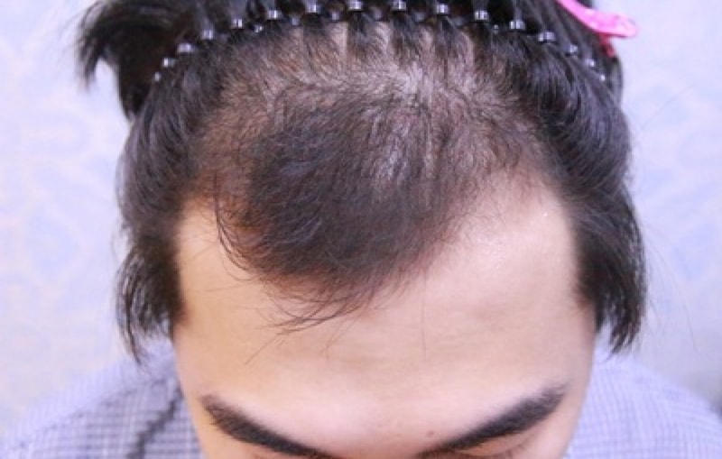 수술전정면.JPG