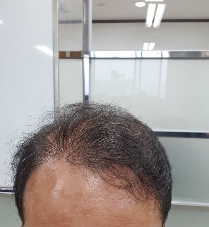 수술 1년 후.jpg