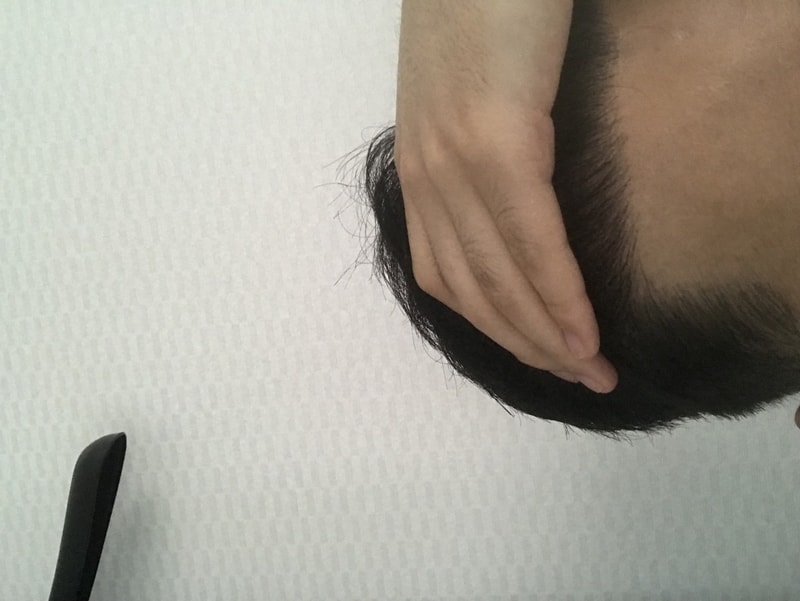 모재성 2600모 비절개 수술 8개월차 후기 올립니다