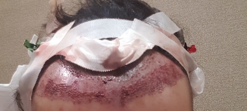 비절개 슬릿 모발이식3000모 후기