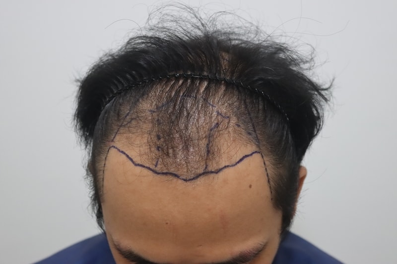 I ended up having a hair transplant.