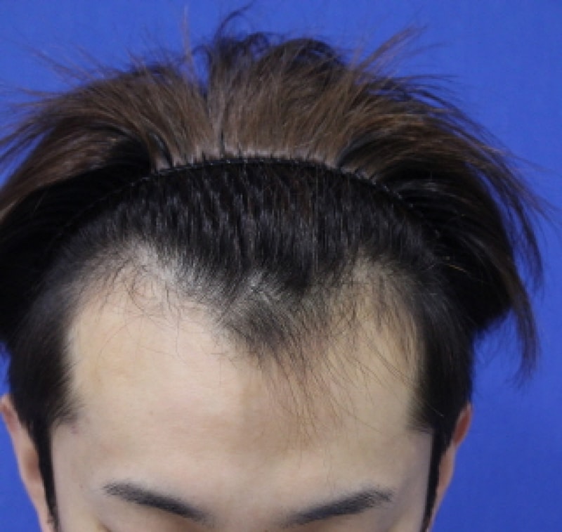 지난 1월10일에 모앤블레스에서 수술받았습니다