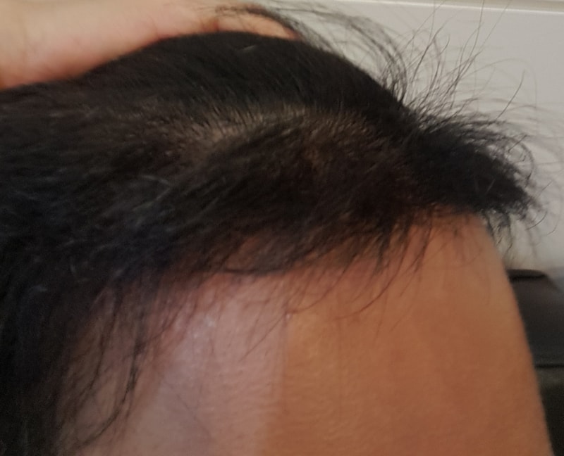 It's been about half a year since I had 1600 hair follicle surgery by non-cut.
