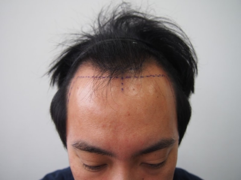 Post a progress photo. immediately before and after surgery