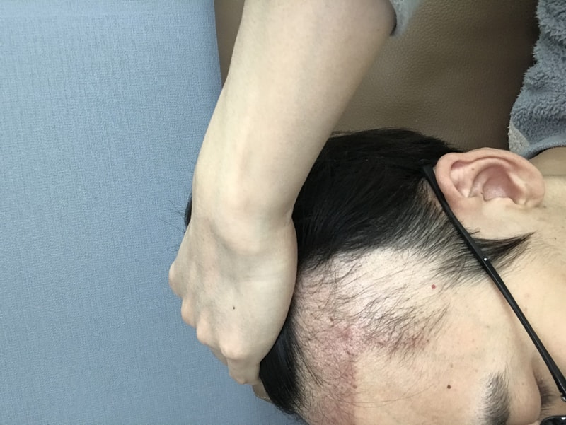 毛髪移植45日目の副作用？ 同伴脱落