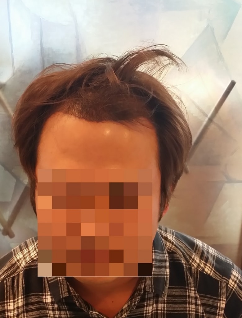 샴푸후(3일)1.jpg